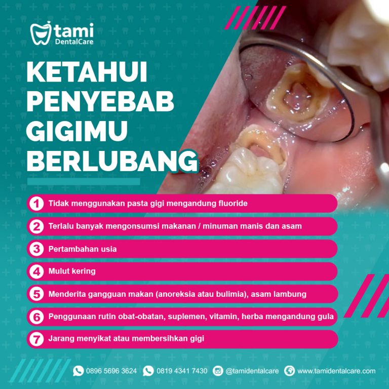 Ketahui Penyebab Gigimu Berlubang Tami Dental Care Klinik Dokter Gigi Bandung Bojongsoang 