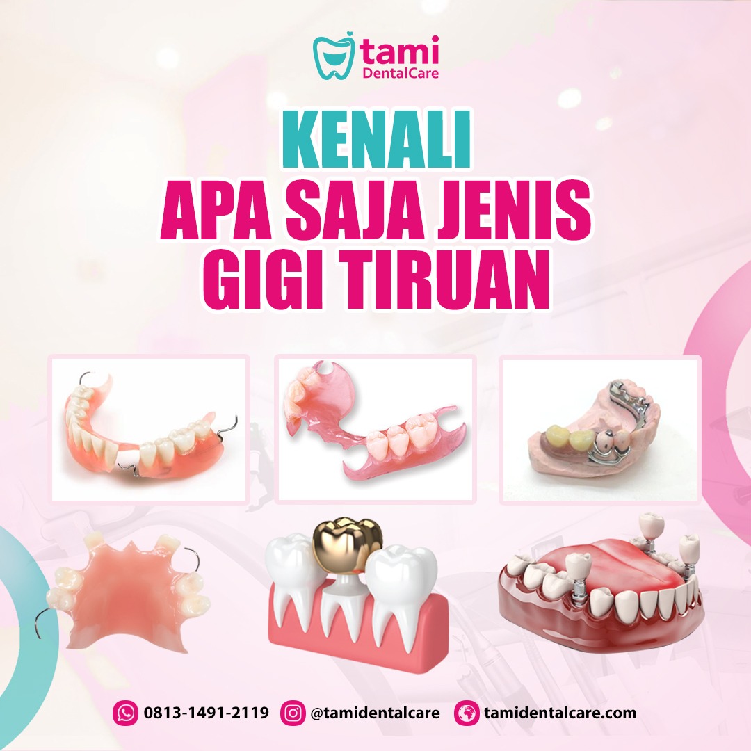 Jenis Jenis Gigi Tiruan Yang Harus Kamu Tahu Tami Dental Care Klinik Dokter Gigi Bandung 