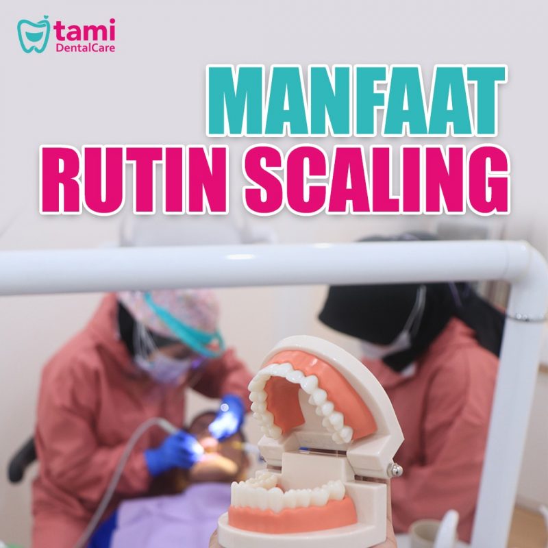 Manfaat Scaling Secara Rutin Tami Dental Care Klinik Dokter Gigi Bandung Bojongsoang Cimahi 