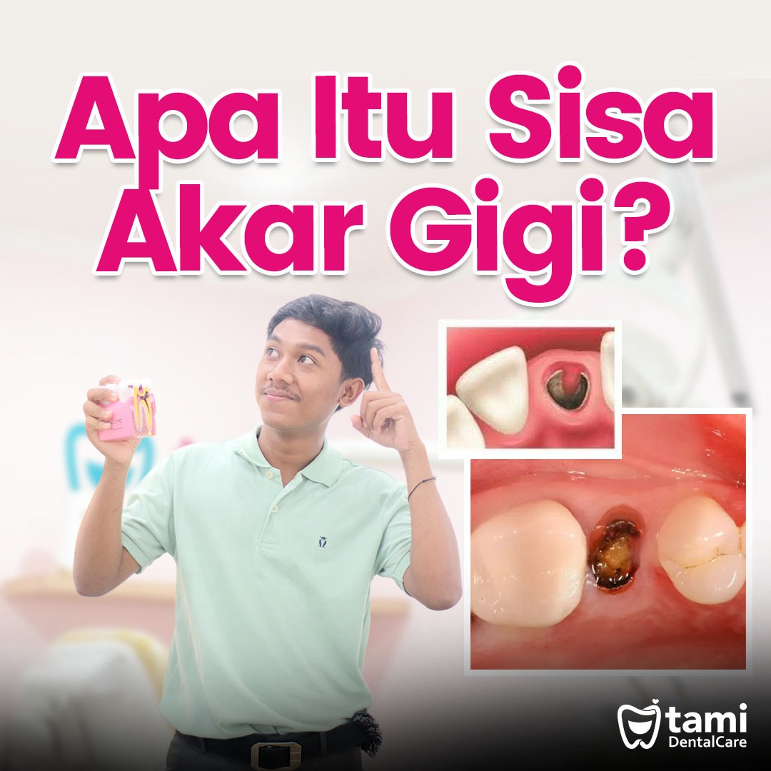 Apa Itu Sisa Akar Gigi Tami Dental Care Klinik Dokter Gigi Bandung Bojongsoang Cimahi 